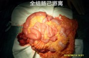 結腸腺癌,結腸腺癌手術治愈率