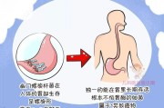 幽門螺旋桿菌癥狀,幽門螺旋桿菌癥