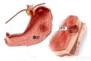 胃潰瘍和胃糜爛哪個(gè)嚴(yán)重？