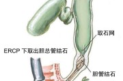 膽管結(jié)石,膽管結(jié)石怎么能排出來了