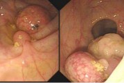 大腸多發息肉大腸多發息肉是什么意思