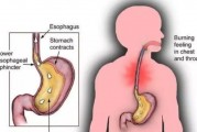關于反流性食管炎最佳治療方法的信息