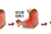 慢性腸胃炎怎么調理飲食慢性腸胃炎