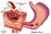 胃潰瘍為什么那么難治愈，吃什么對胃潰瘍痊愈有幫助呢？