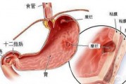 有慢性胃炎，吃什么養胃？