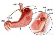 胃潰瘍和十二指腸潰瘍的區別在哪，會癌變嗎？