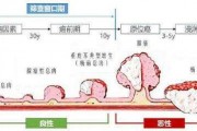 腸癌早期癥狀,警惕腸癌早期四大征兆