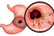 教你幾招自測幽門螺桿菌幽門螺旋桿菌的癥狀