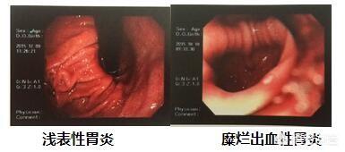 體檢檢查出來有胃炎怎么辦<strong>胃炎</strong>？