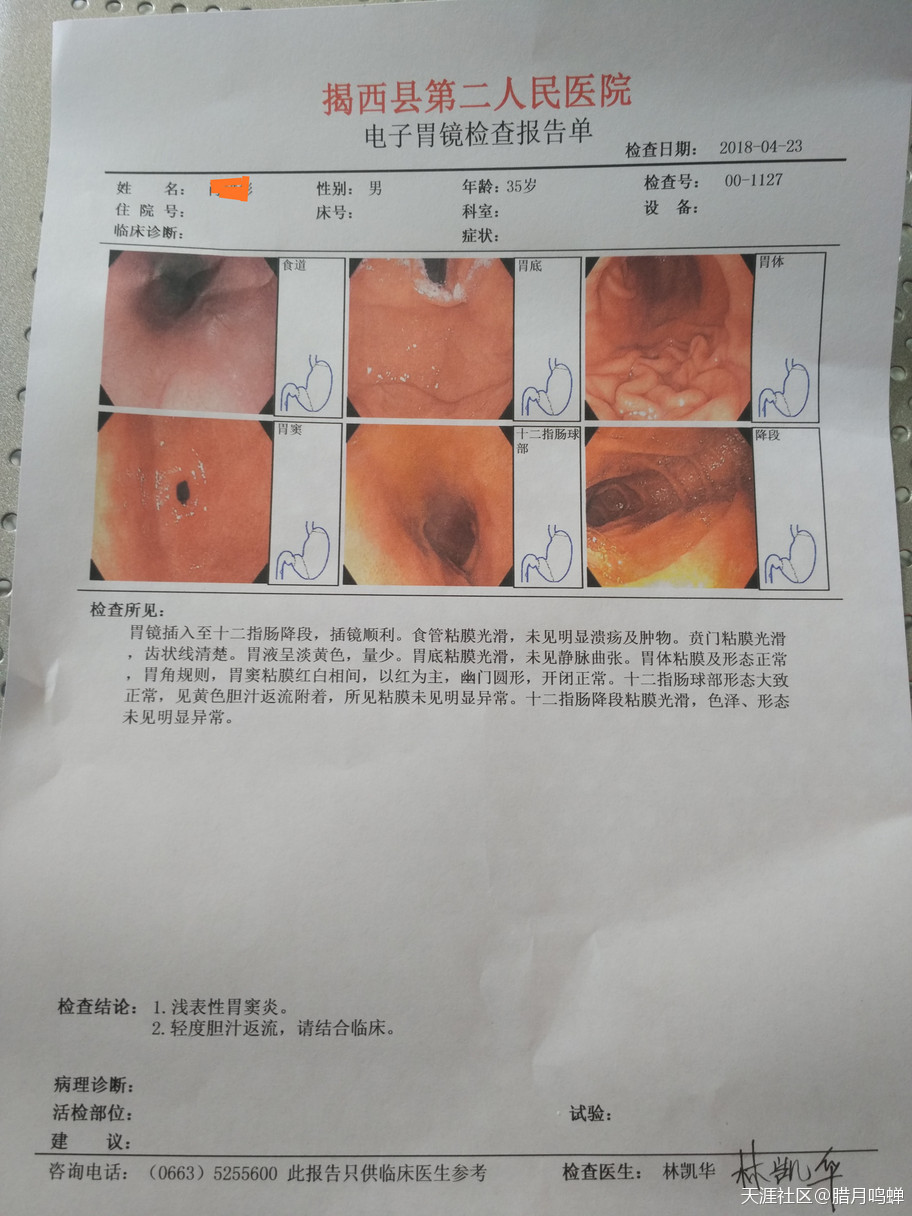 物理方法控制膽汁反流性胃炎