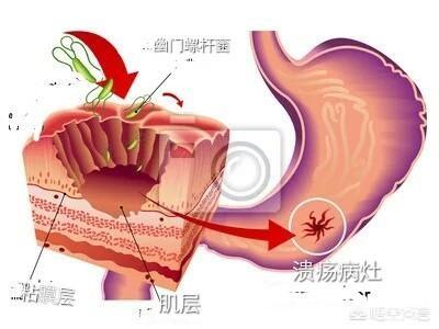 有胃潰瘍能喝乳酸菌嗎<strong>胃潰瘍</strong>？