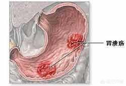 胃潰瘍還能喝酒嗎<strong>胃潰瘍</strong>？