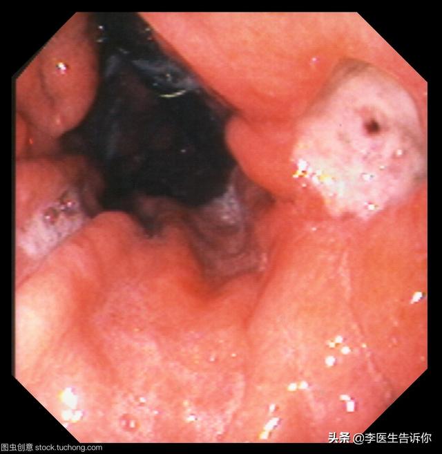 胃潰瘍是萎縮性胃炎嗎<strong>胃潰瘍</strong>？容易癌變嗎？