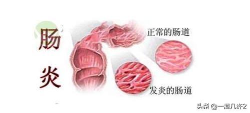 腸炎惡化都有哪些表現(xiàn)<strong>腸炎</strong>？