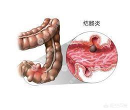 在醫院檢查出慢性腸炎<strong>腸炎</strong>，有什么好的治療方法？