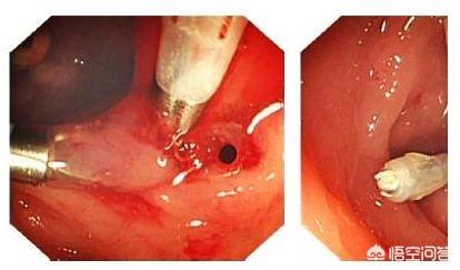 為什么胃潰瘍就變成了胃穿孔<strong>胃潰瘍</strong>？