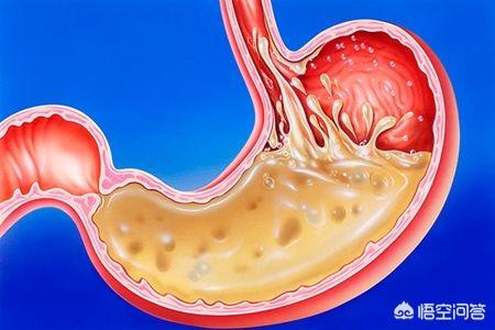 為什么會胃疼、胃酸<strong>胃脘痛</strong>？如何緩解？
