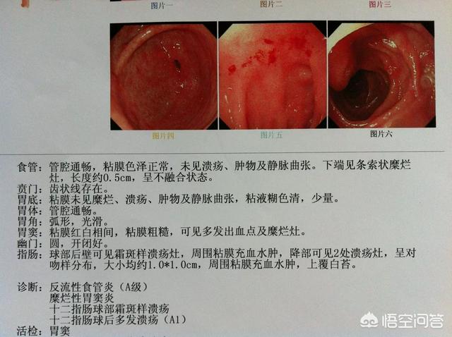 十二指腸潰瘍吃什么藥好<strong>十二指腸</strong>？