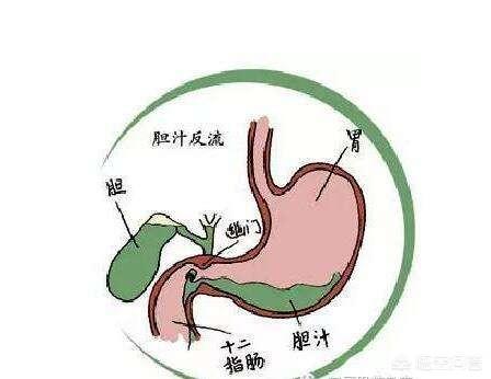 什么是十二指腸胃反流<strong>十二指腸</strong>？