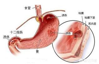 胃潰瘍和十二指腸潰瘍的區別在哪<strong>十二指腸</strong>，會癌變嗎？