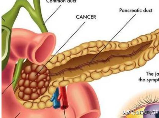 胰腺癌一般哪里會(huì)出現(xiàn)疼痛<strong>十二指腸</strong>？