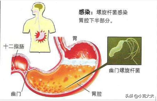 糜爛性胃炎十二指腸炎吃什么藥最好<strong>十二指腸</strong>？