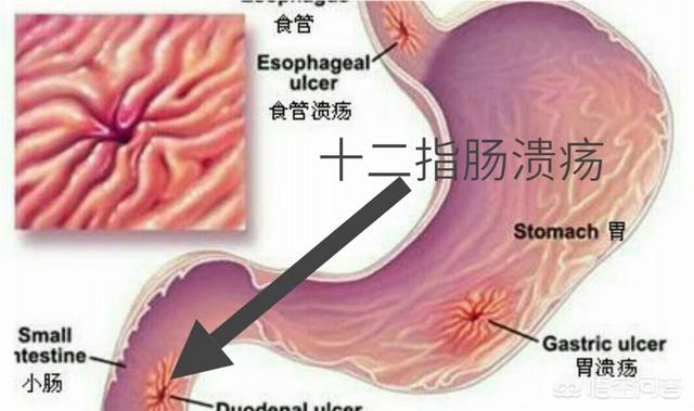 查出十二指腸潰瘍<strong>十二指腸</strong>，服藥二個月，為什么還有黑便？