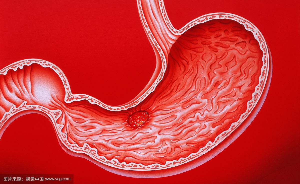 胃癌最明顯的一個征兆,胃癌