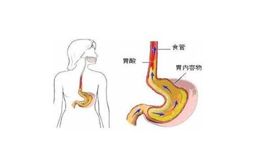 胃食管反流吃什么藥最好,胃食管返流