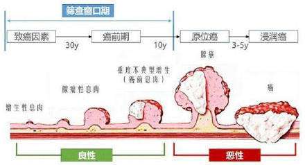 腸癌早期癥狀,警惕腸癌早期四大征兆