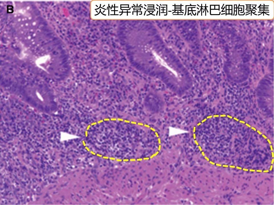 潰瘍性結腸炎終身忌口潰瘍性結腸炎