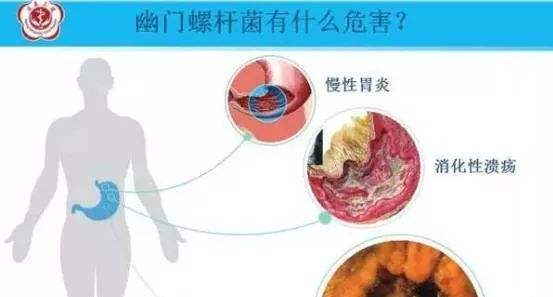 包含幽門螺旋桿菌感染什么癥狀的詞條