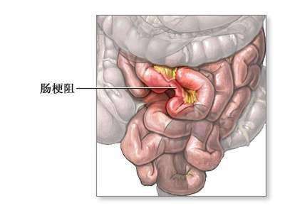 腹痛腹脹腹痛腹脹惡心消化不良