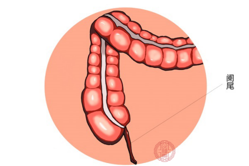 盲腸炎,盲腸炎疼痛位置圖