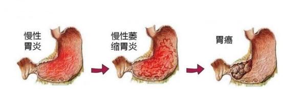 慢性腸胃炎怎么調理飲食慢性腸胃炎