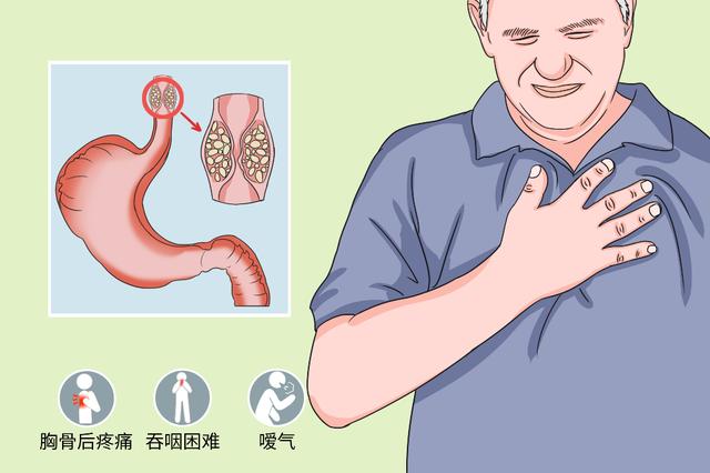 老年人食道癌癥狀食道癌癥狀