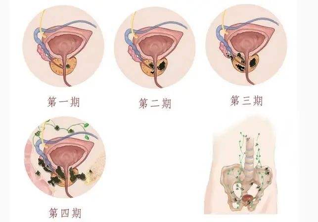 前列腺鈣化什么意思有什么影響前列腺鈣化什么意思